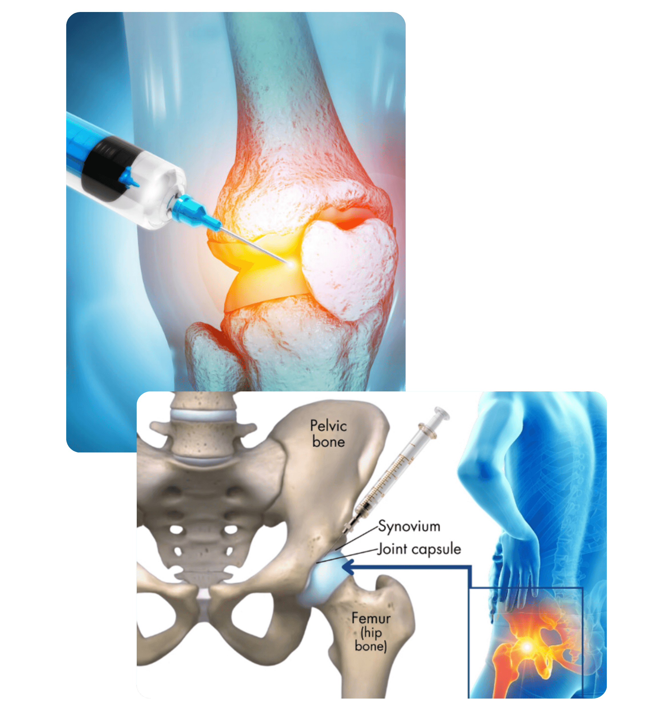 Osteoarthritis Treatment